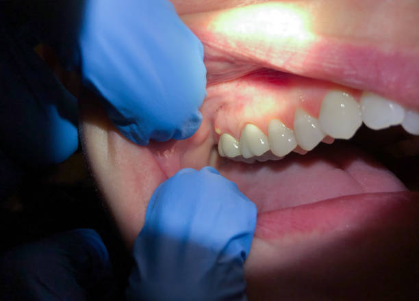 Best Broken Tooth Emergency  in Chackbay, LA